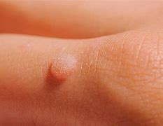 Image result for Mole Genital Warts