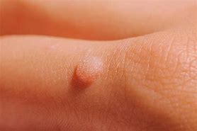 Image result for Flat Warts