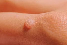 Image result for Common Wart On Knee