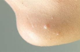 Image result for Molluscum Contagiosum On Hand Adults