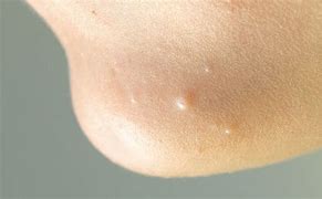 Image result for Molluscum Contagiosum Back Acne