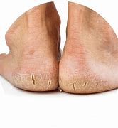 Image result for Skin Conditions On Feet