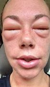 Image result for Skin Allergy Rash Treatment