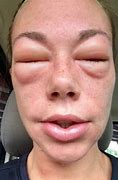 Image result for Antibiotic Allergy