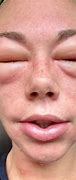 Image result for Malt Allergy