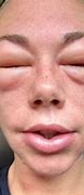 Image result for Face Allergy