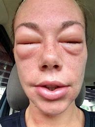 Image result for PPD Allergy Symptoms