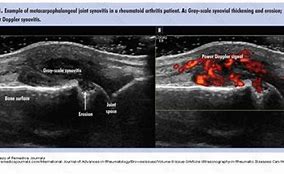 Image result for Rheumatoid Arthritis Ultrasound