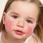 Image result for Food Allergy Skin Rash