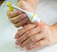 Image result for Allergic Eczema