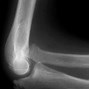 Image result for Nail-patella Syndrome