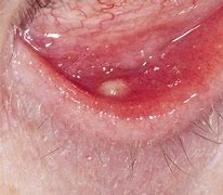 Image result for Cyst On Eyelid