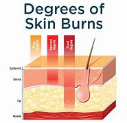 Image result for 2nd Degree SunBurn