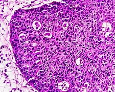 Image result for Squamous Cell Carcinoma On Tongue