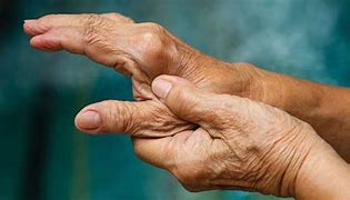 Image result for Arthritis in Thumb