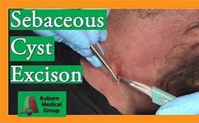Image result for Sebaceous Cyst Scalp Removal
