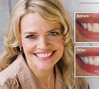 Image result for What Is the Difference Between Ceramic and Porcelain Teeth