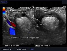 Image result for Ovarian Dermoid Cyst
