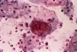 Image result for Genital Herpes