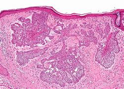 Image result for Irritated Basal Cell Papilloma