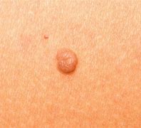 Image result for Warts Thigh