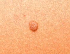 Image result for Skin Warts On Back