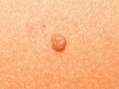 Image result for Blood Skin Tags