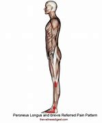 Image result for Peroneus Brevis Trigger Points