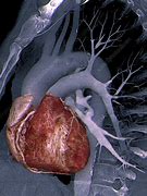 Image result for Heart CT Scan