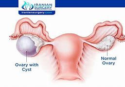 Image result for How Big Is 4 Centimeter Cyst