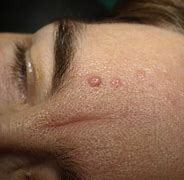 Image result for Verrucous Seborrheic Keratosis