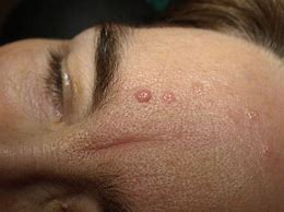 Image result for Cluster of Holes in Skin