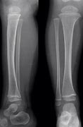 Image result for Child with Broken Leg
