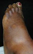 Image result for 5th Metatarsal Fracture