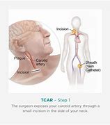 Image result for Carotid Endarterectomy Surgery