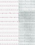 Image result for Apple Watch 12 Lead EKG