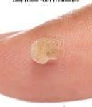 Image result for Home Remedies for Warts