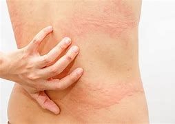Image result for Itchy Skin Allergy