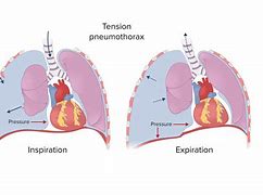Image result for Assessing a Tension Pneumothorax