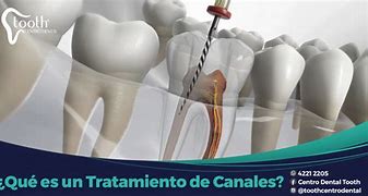 Image result for canaladura