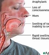 Image result for Allergic Reaction in Mouth