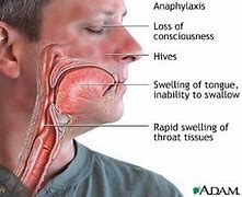 Image result for Food Allergy