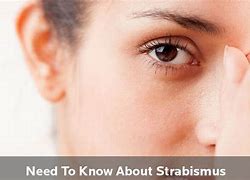 Image result for strabilis