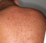 Image result for Chicken Pox On Dark Skin