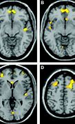 Image result for Migraine Brain Tumor