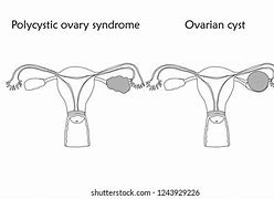 Image result for 5 Cm Ovarian Cyst Chart