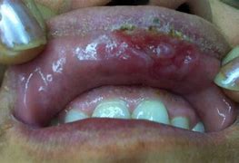 Image result for Syphilis Mouth Ulcer
