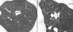 Image result for Solitary Pulmonary Nodule Radiology Assistant