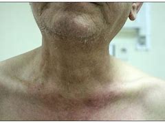 Image result for 2 Cm Lymph Node