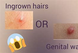 Image result for Male Genital Warts Symptoms